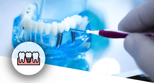  مراقبت های ایمپلنت دندان