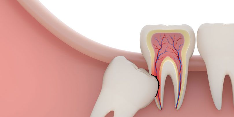 علت انجام جراحی دندان عقل