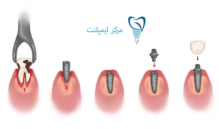 ایمپلنت دندان چگونه انجام می شود 