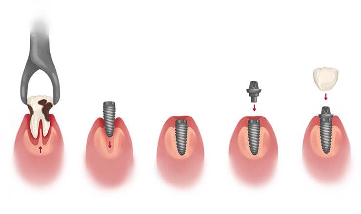 مراحل ایمپلنت دندان به ترتیب