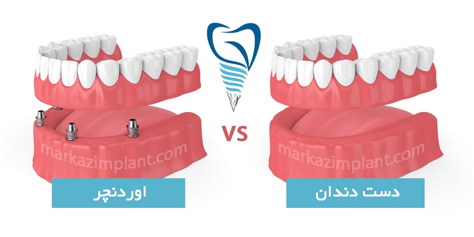 تفاوت اوردنچر و دست دندان