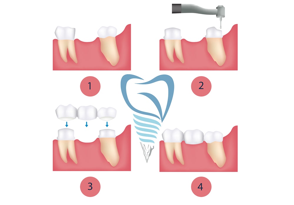 مراحل بریج دندان