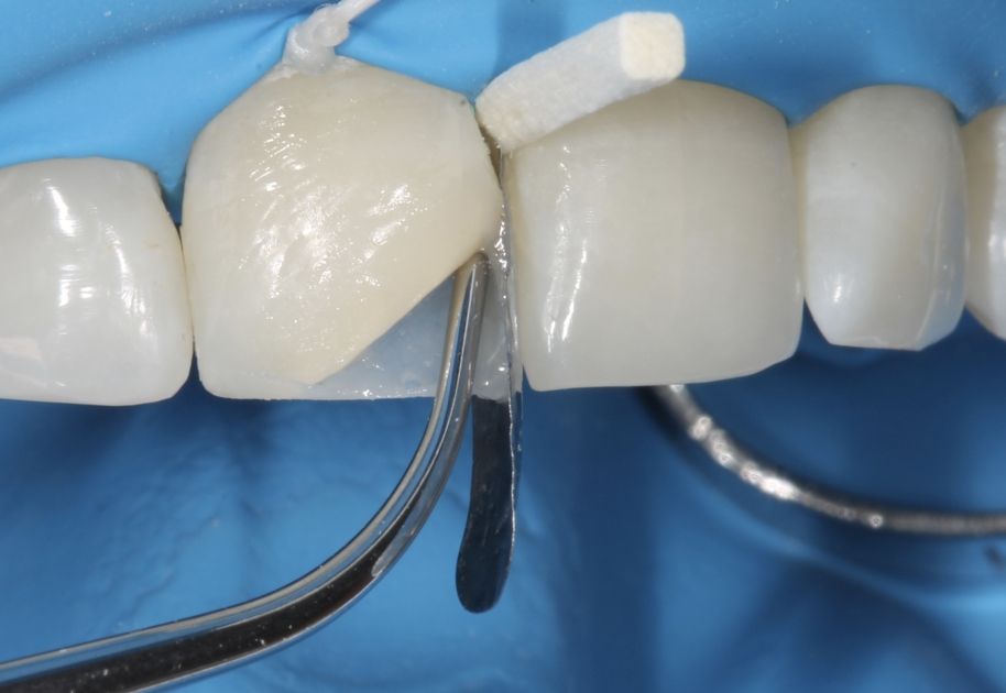 مراحل انجام کامپوزیت دندان چگونه است؟