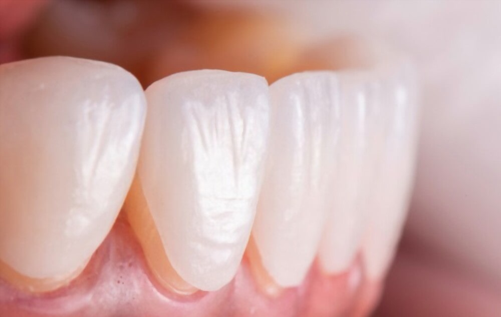 تفاوت کاربرد کامپوزیت و لمینت دندان 