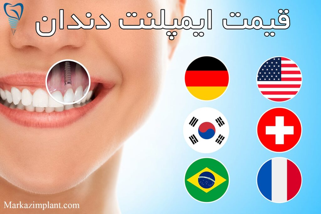 قیمت ایمپلنت دندان تهران 1401
