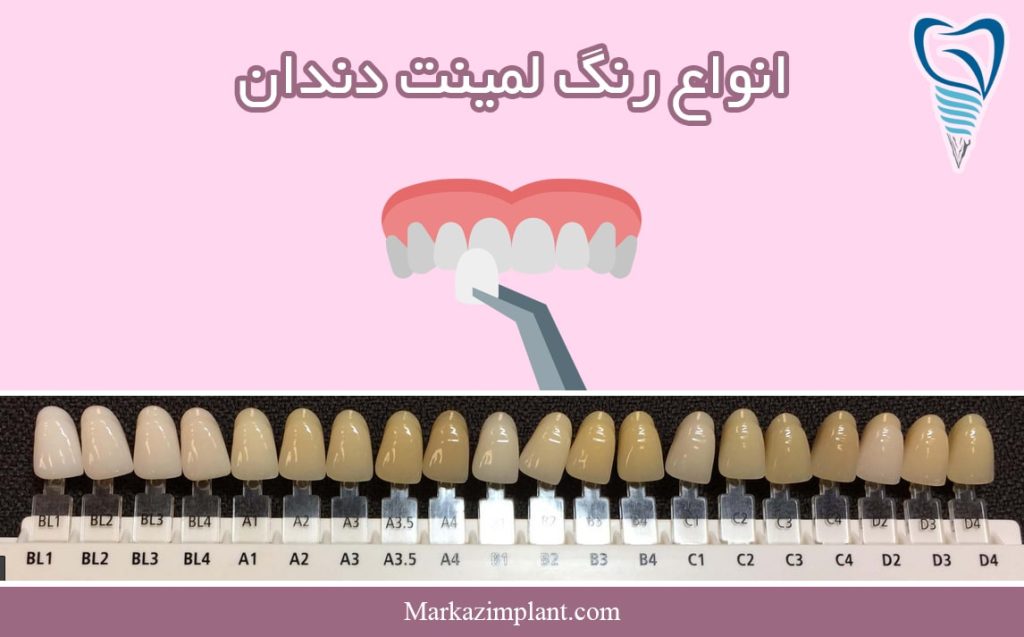 انواع رنگ لمینت دندان