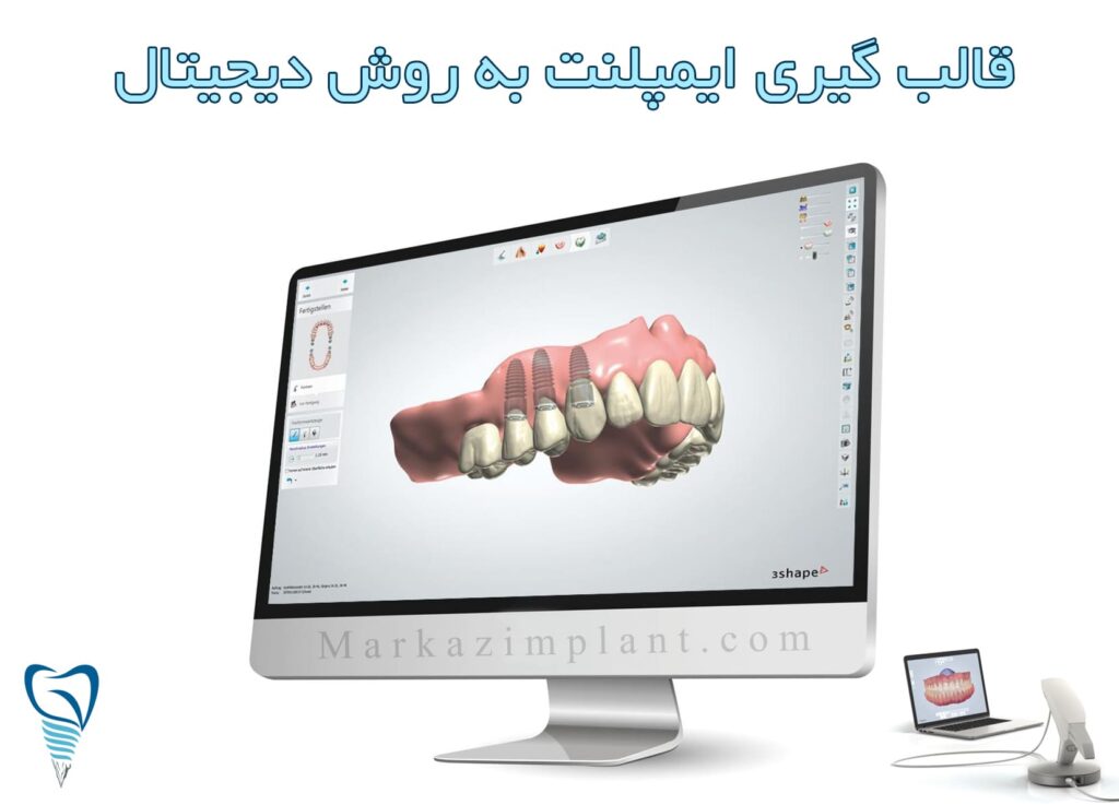 قالب گیری ایمپلنت دندان به روش دیجیتال