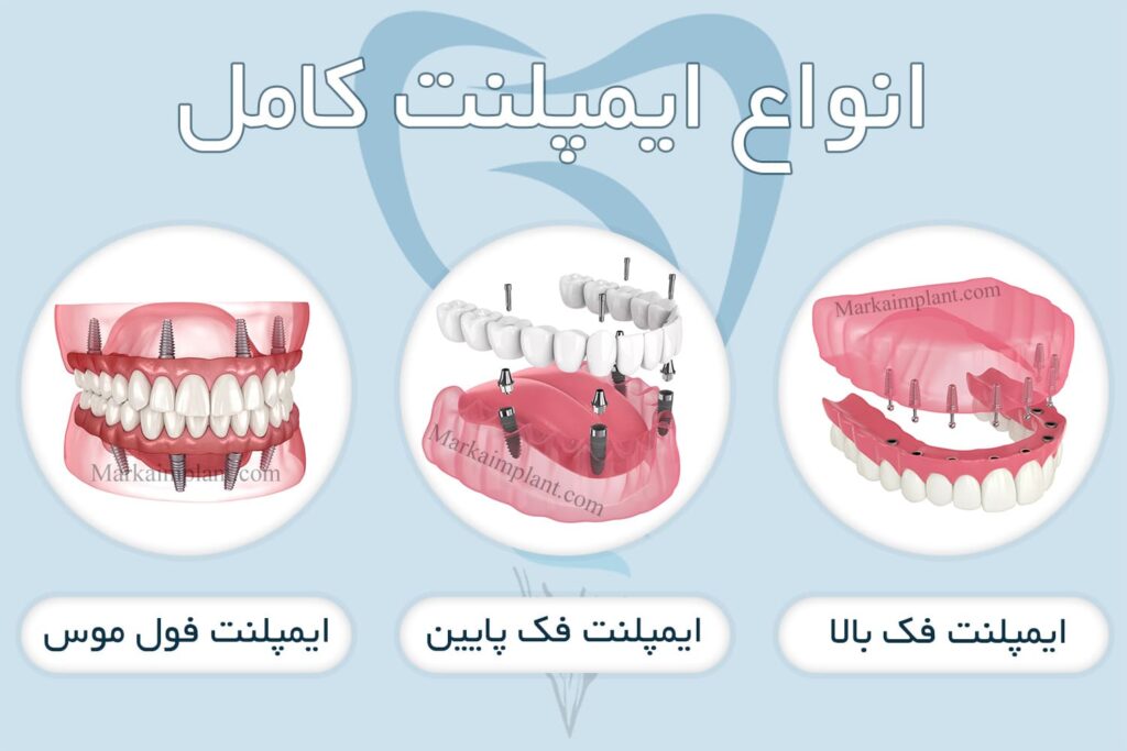 انواع ایمپلنت کامل از نظر میزان بی دندانی
