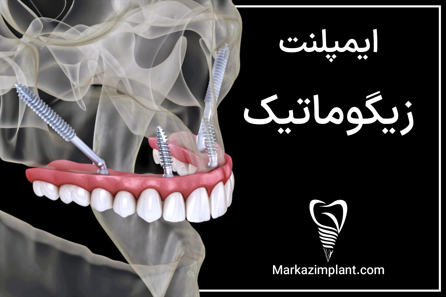 ایمپلنت زیگوماتیک