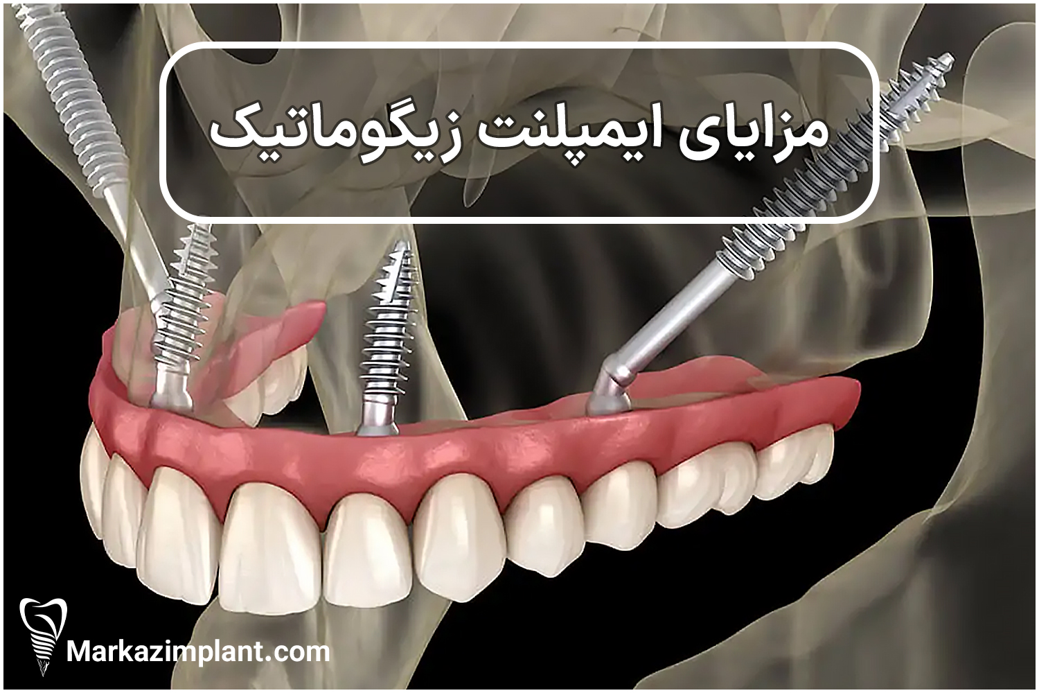 مزایای ایمپلنت زیگوماتیک