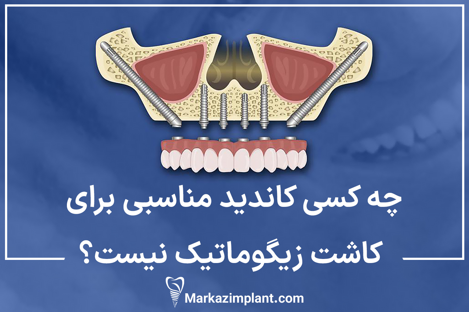 چه کسی کاندید مناسبی برای کاشت زیگوماتیک نیست؟