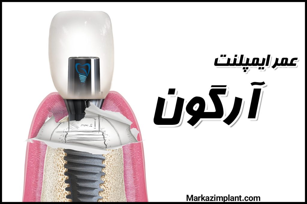 عمر ایمپلنت آرگون