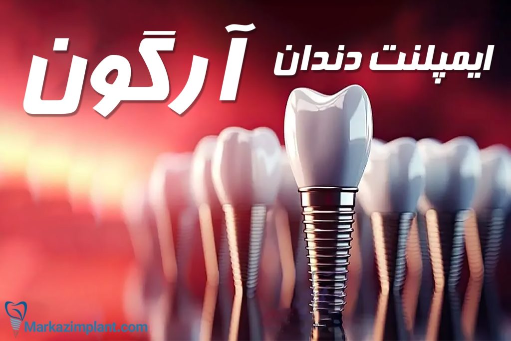ایمپلنت دندان آرگون