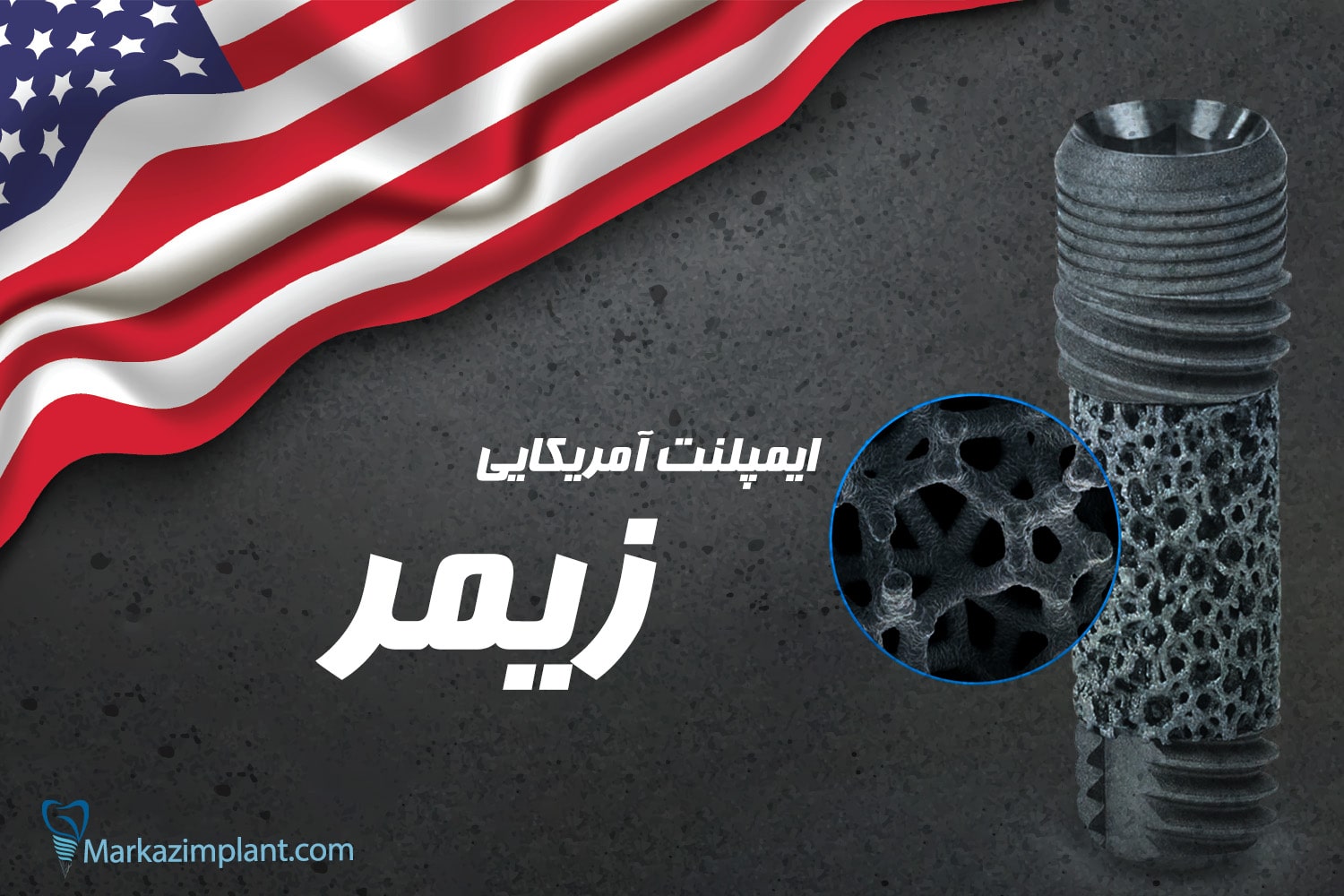 ایمپلنت آمریکایی زیمر
