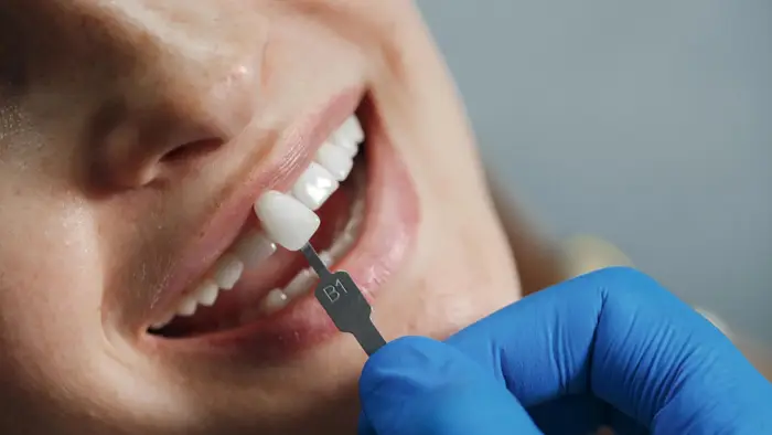 ایمپلنت دندان