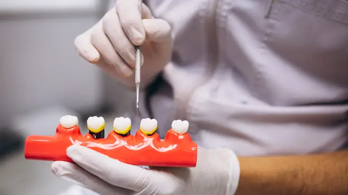 ایمپلنت دندان