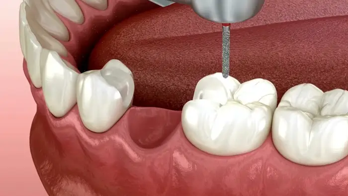جای خالی دندان