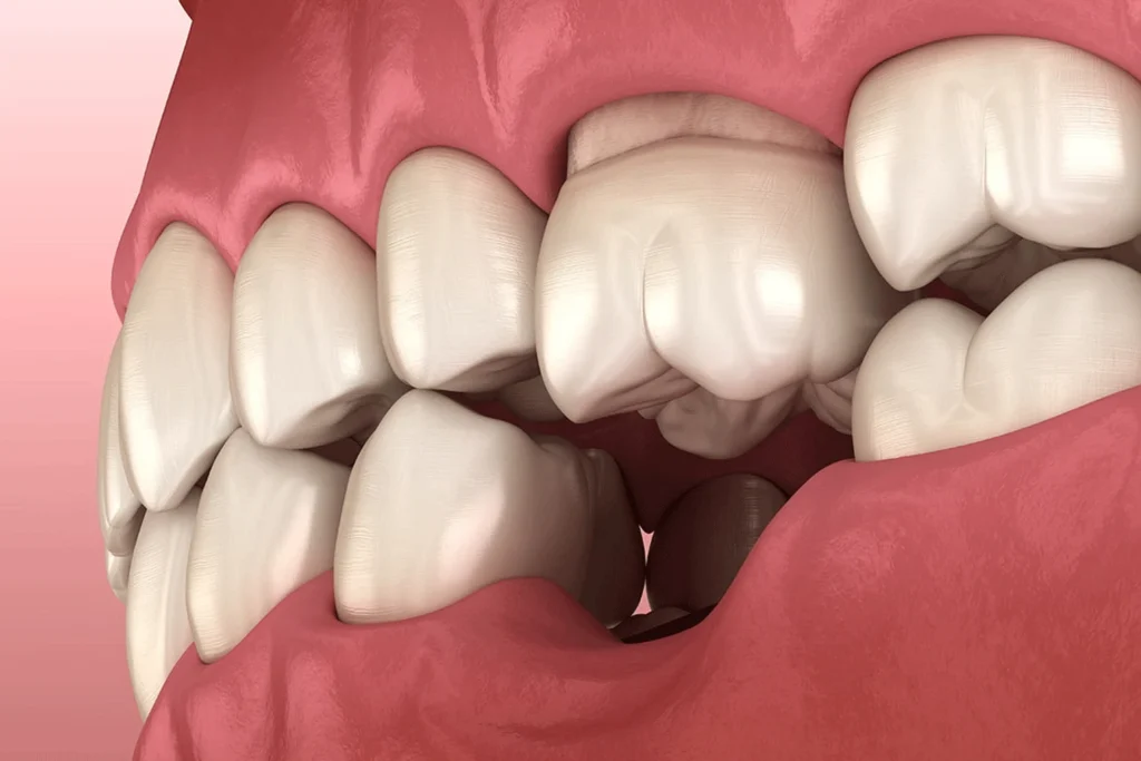 عوارض جای خالی دندان