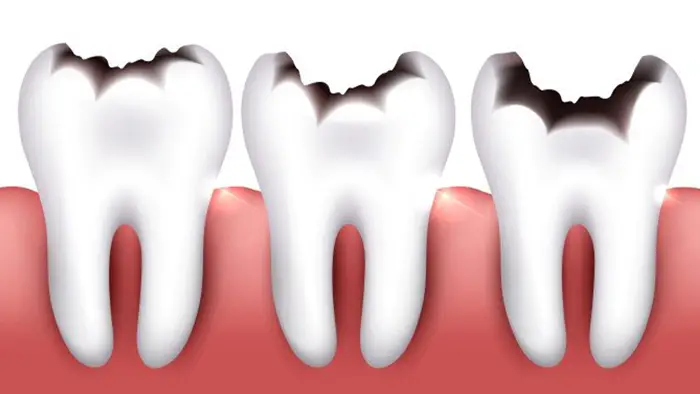 پوسیدگی دندان