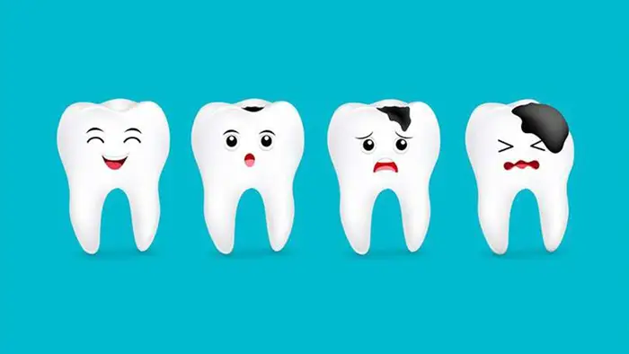 پوسیدگی دندان