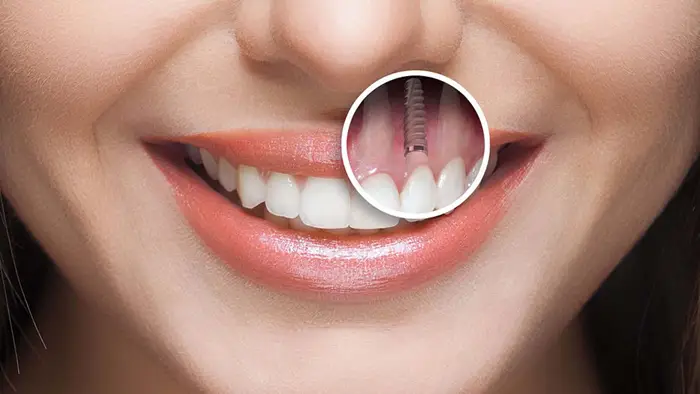 بیمه ایمپلنت دندان