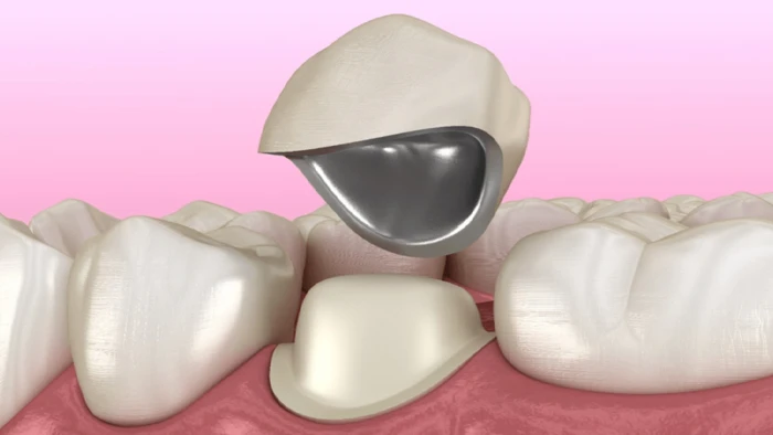 روکش دندان PFM