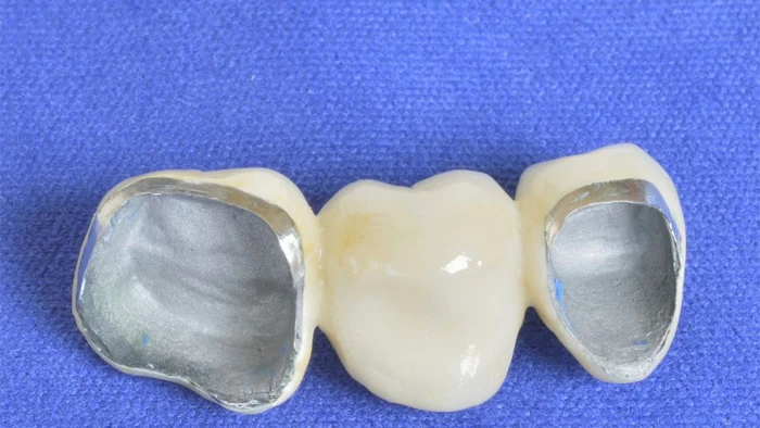 روکش دندان PFM