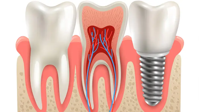 ایمپلنت دندان