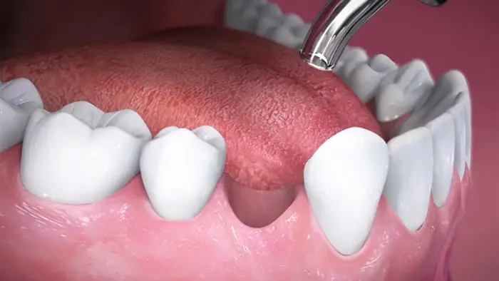 جای دندان خالی