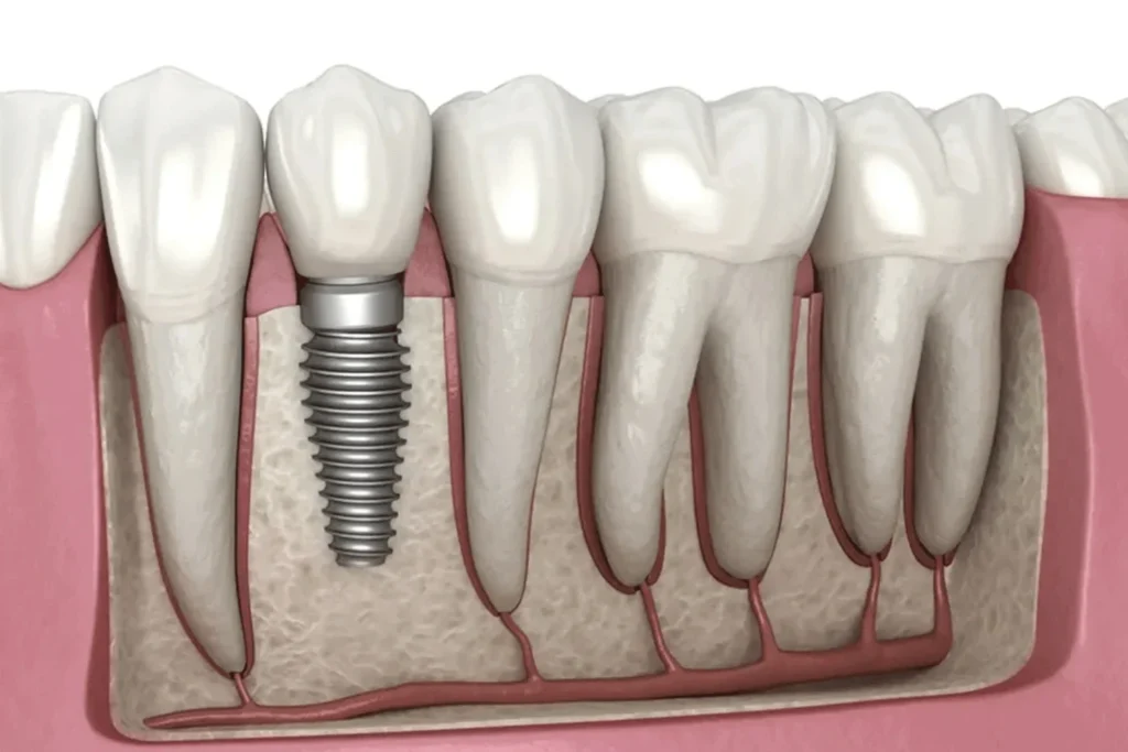 سقف پوشش بیمه ایمپلنت دندان