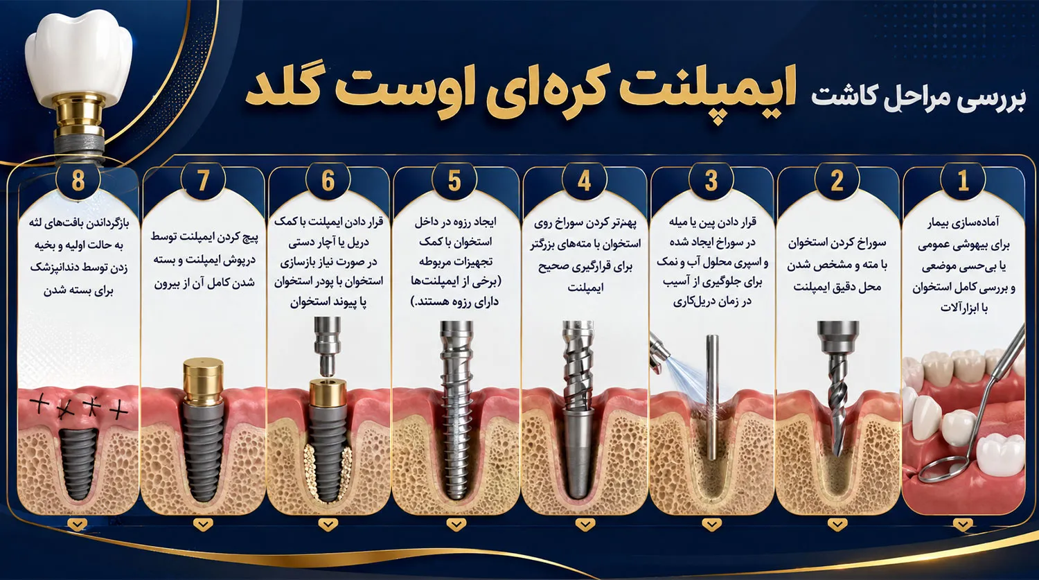 مراحل کاشت ایمپلنت اوست گلد avest gold implant placement steps