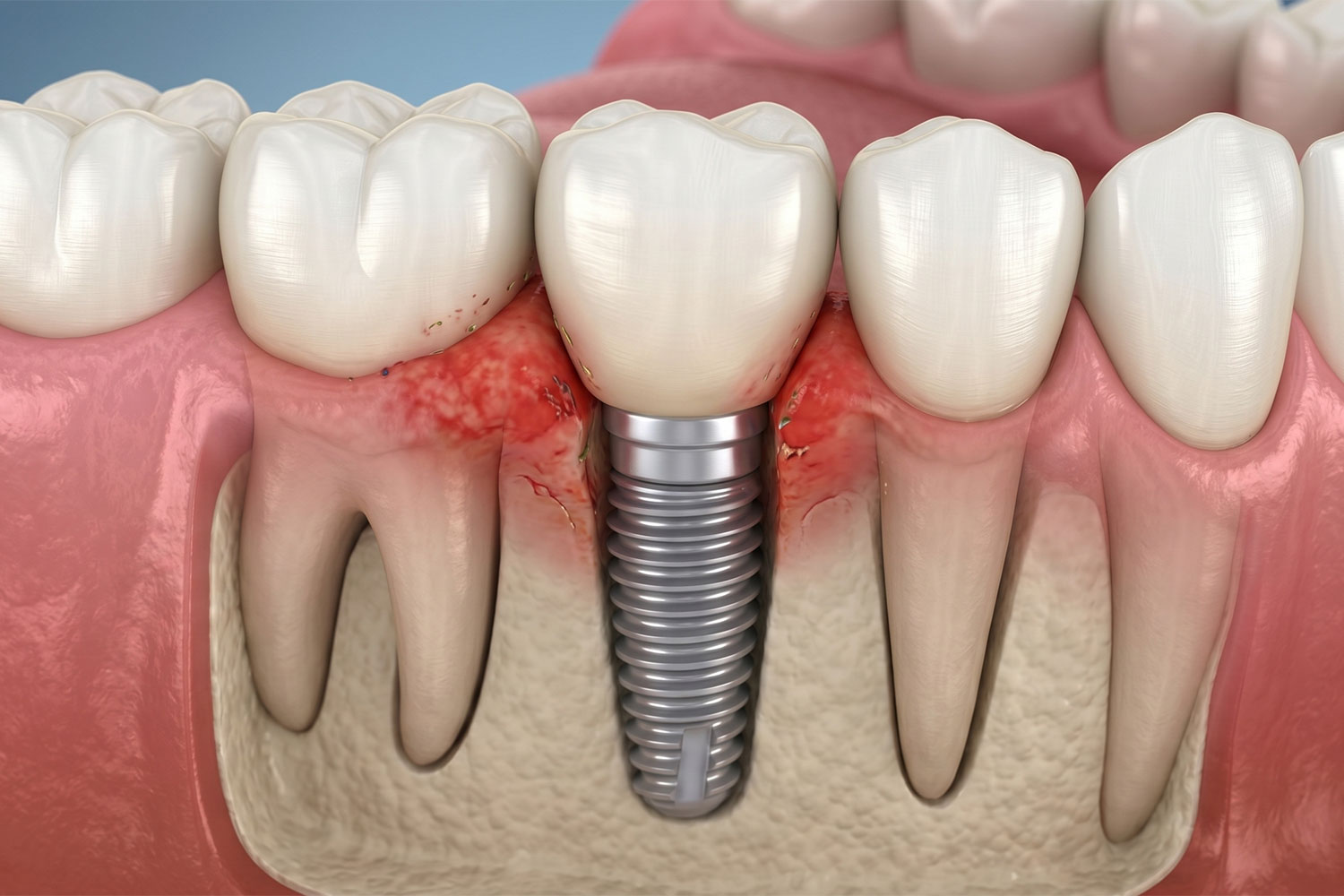 خراب شدن ایمپلنت دندان can dental implant get damaged guide