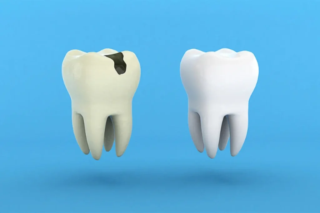پوسیدگی دندان dental-caries