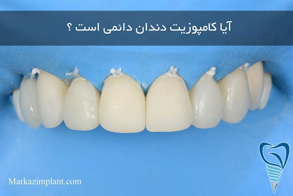 آیا کامپوزیت دندان دائمی است 