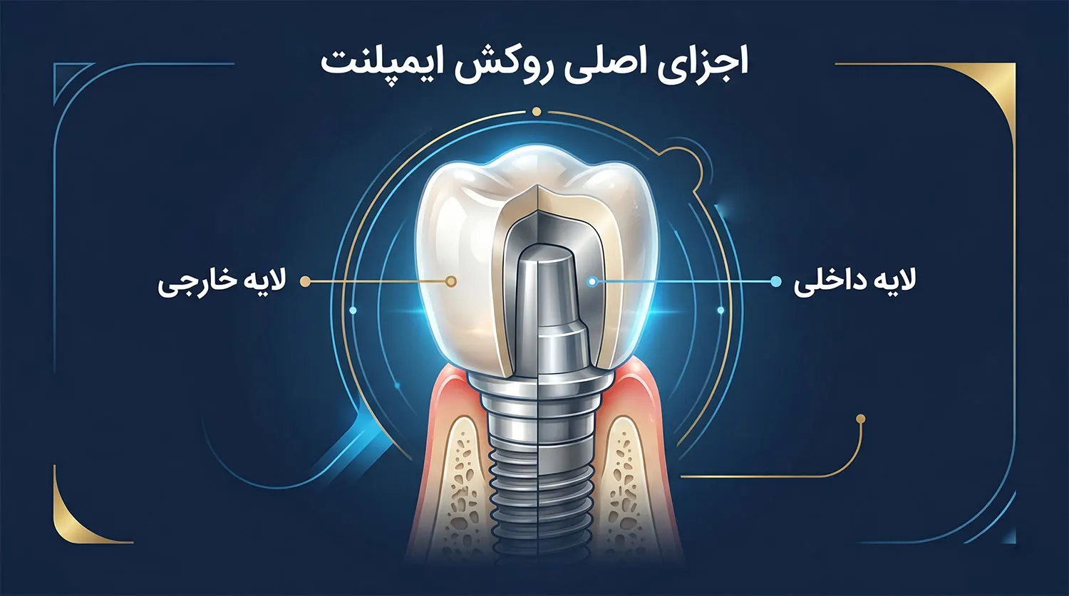 اجزای اصلی روکش ایمپلنت