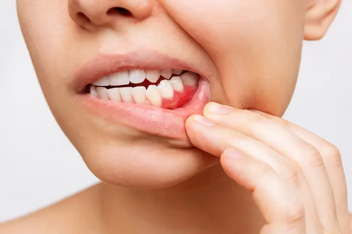 بیماریهای دهان و دندان dental disease