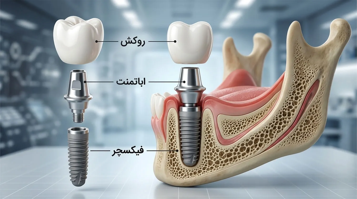 اجزای اصلی ایمپلنت دندان dental implant components
