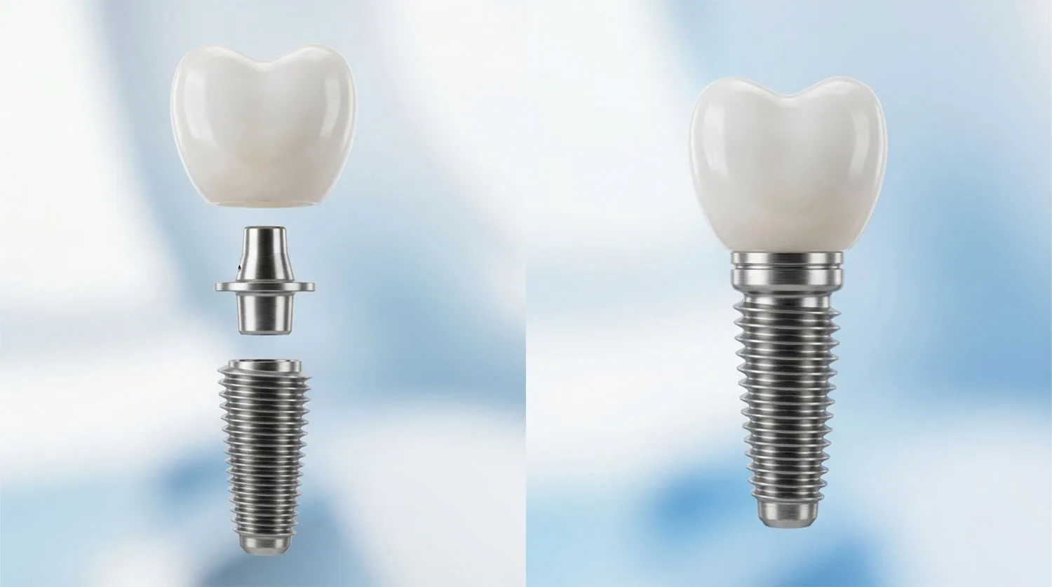 اجزای اصلی ایمپلنت دندان dental implant components