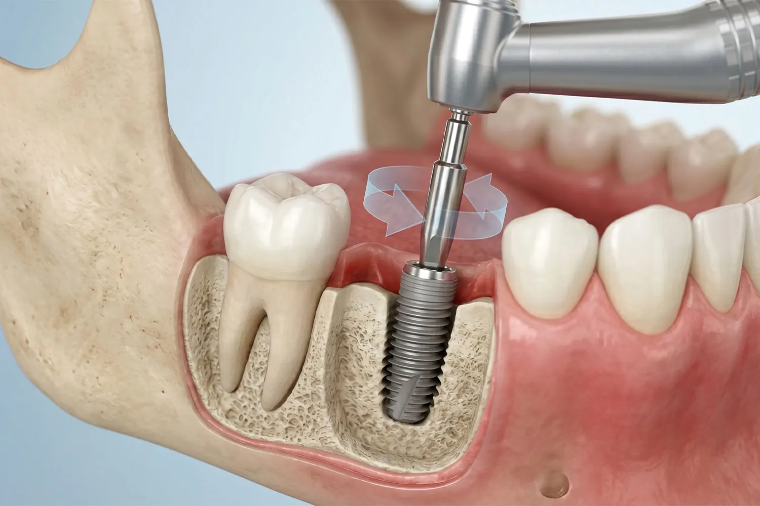 راهنمایی جراحی ایمپلنت دندان dental implant surgery guide