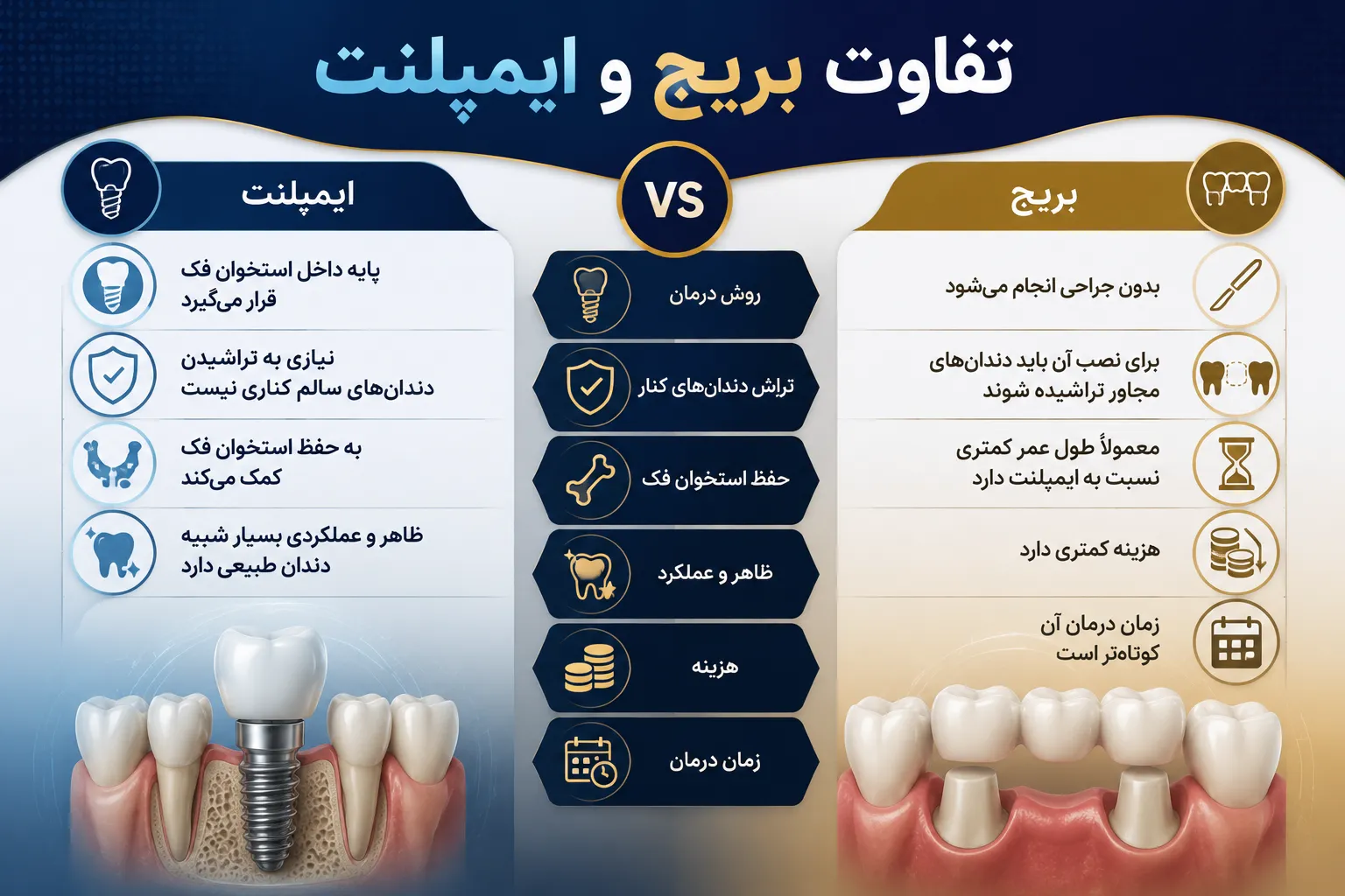 تفاوت ایمپلنت و بریج