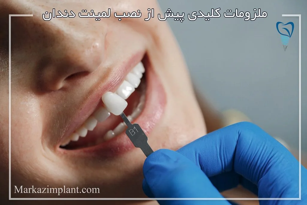 ملزومات پیش از لمینت دندان