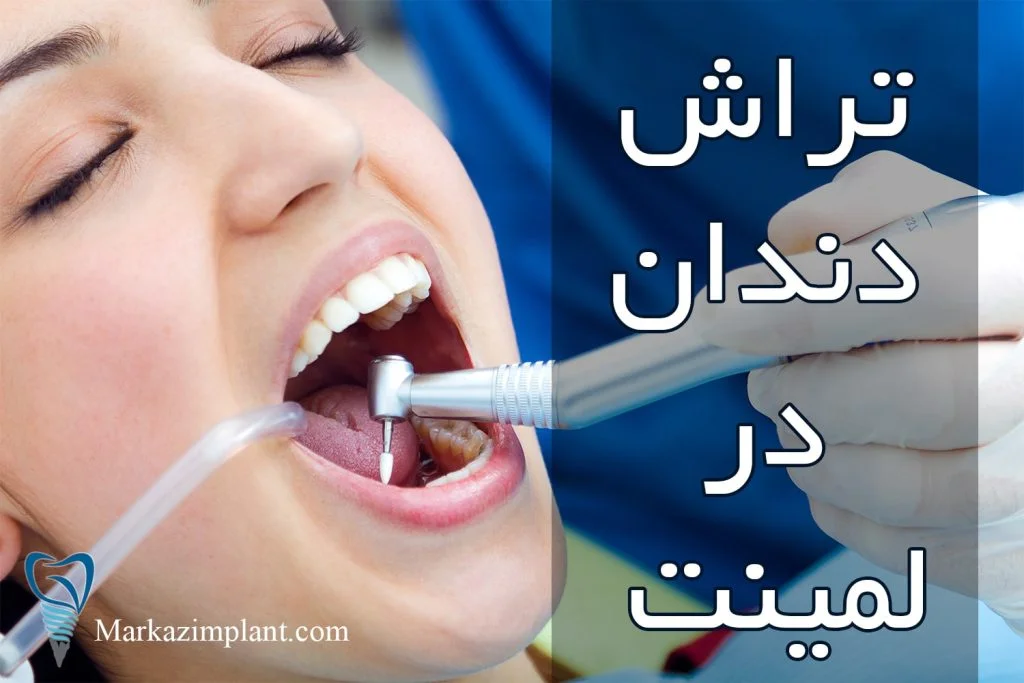 تراش دندان در لمینت