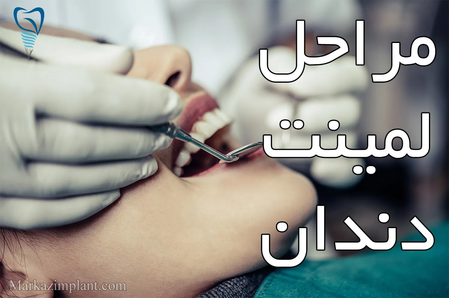 مراحل لمینت دندان dental laminate process