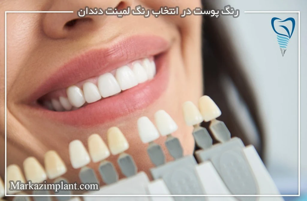 تاثیر رنگ پوست در انتخاب لمینت دندان