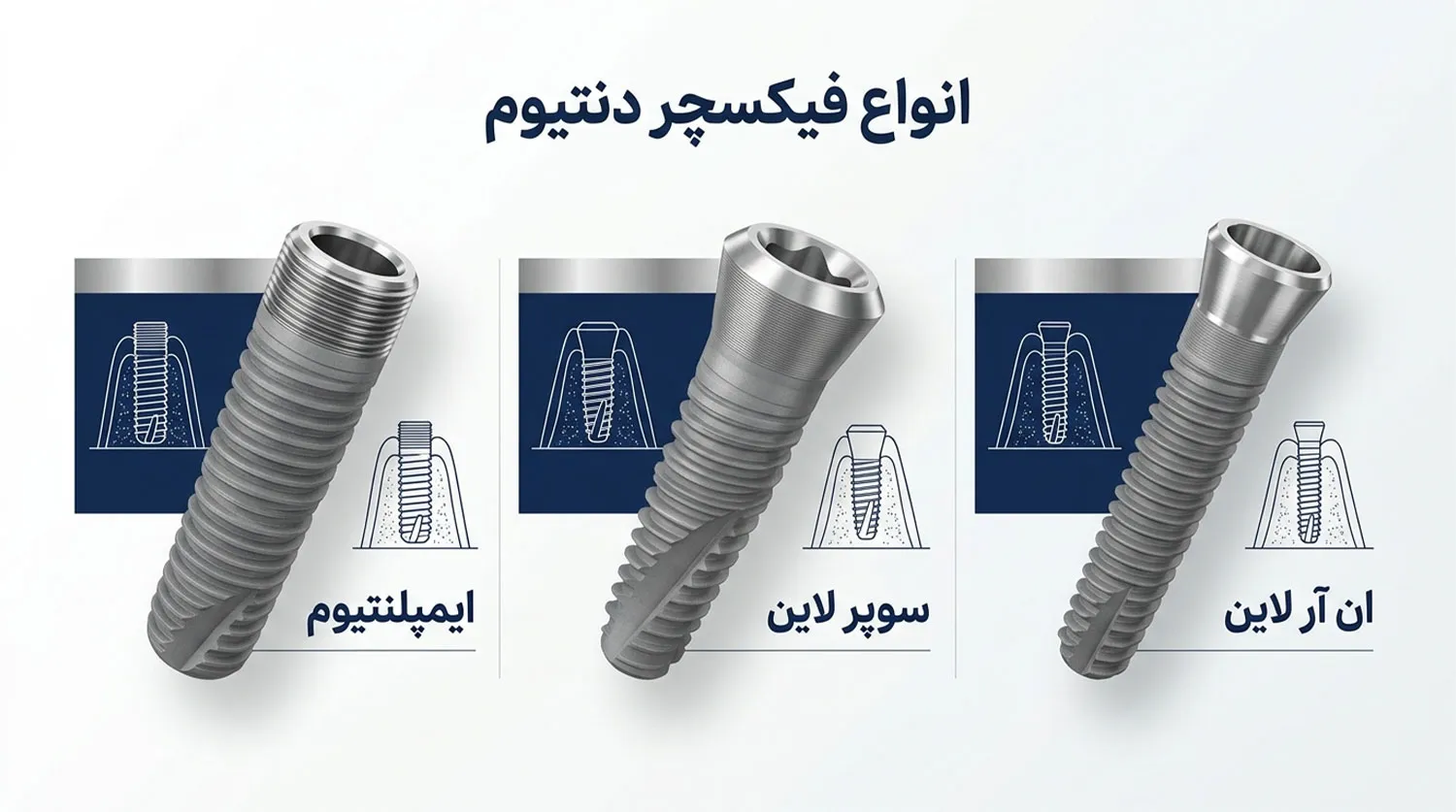 انواع فیکسچر ایمپلنت دنتیوم dentium implant fixture types