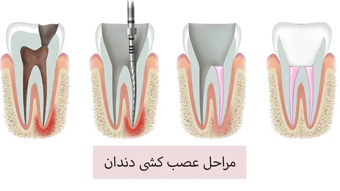 مراحل عصب‌کشی دندان