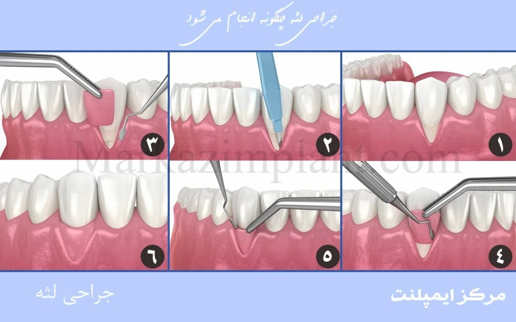 مراحل پیوند لثه gum surgery step