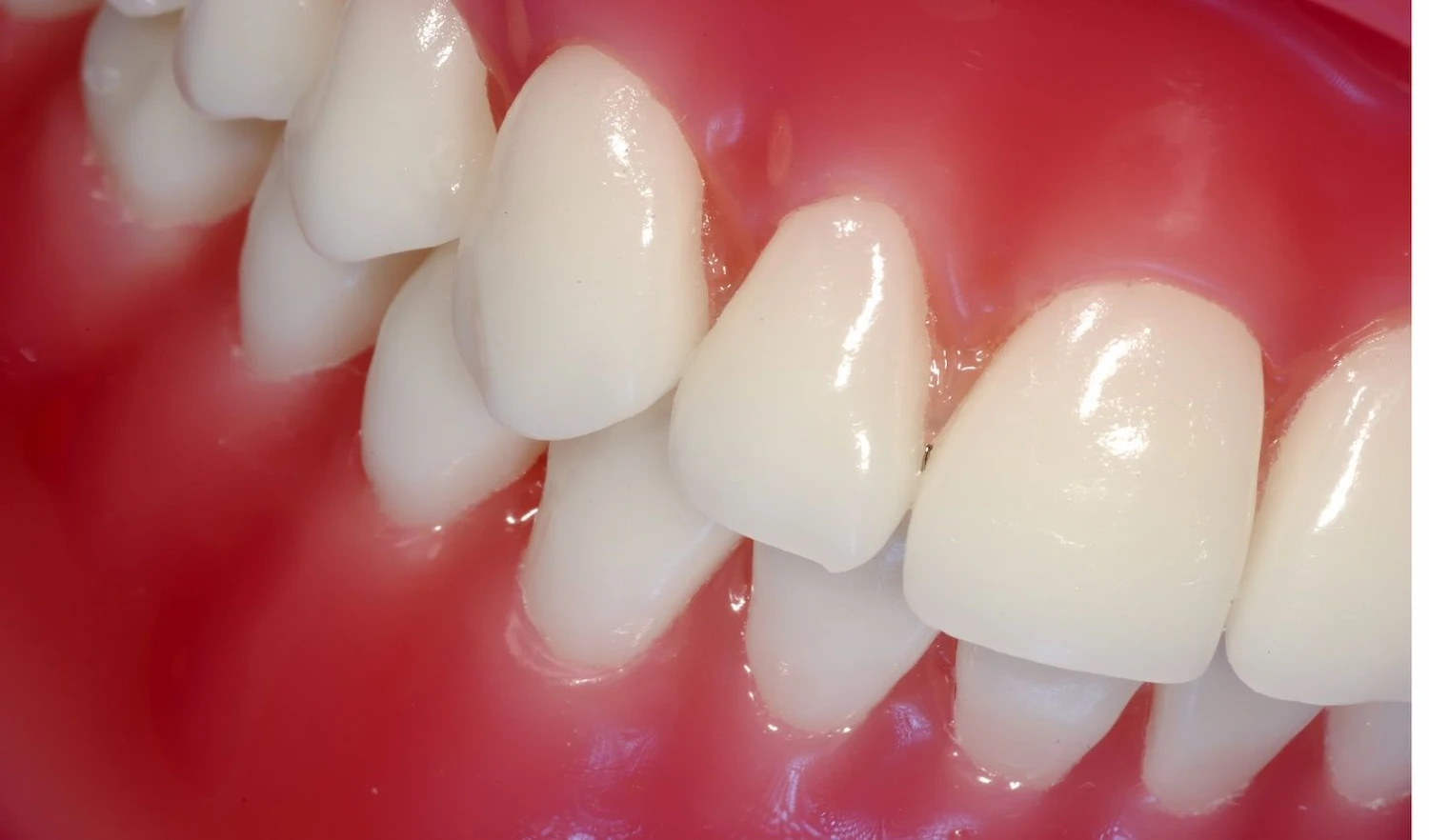 جراحی لثه gum surgery