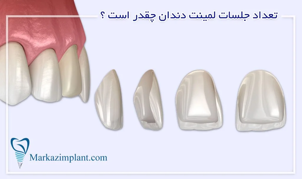 تعداد جلسات لمینت دندان