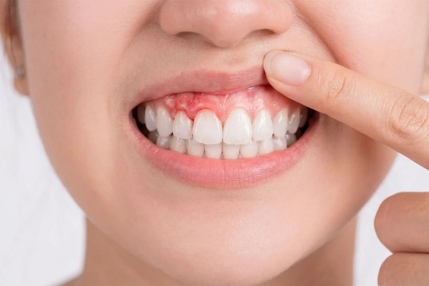 التهاب و سفید شدن لثه بعد از ایمپلنت implant gum inflammation